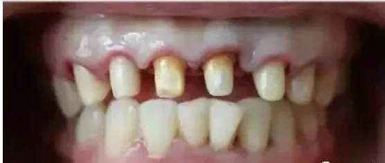 早年牙齿就有点龅牙. 但是其本质,是把人原来的牙齿磨小,放上烤瓷冠.