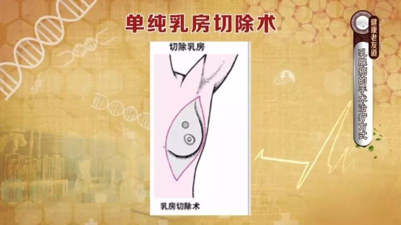 乳房有肿块不疼不痛是乳腺癌吗?自测乳腺癌的方法在这里!