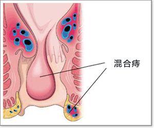 ④静脉曲张性外痔:肛缘周围皮下曲张的静脉团,下蹲腹压增加,排便时