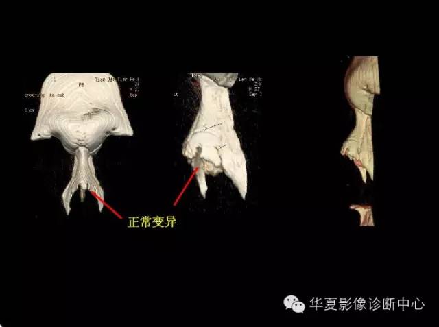 标本 影像,深度剖析 — 鼻骨,鼻副窦解剖