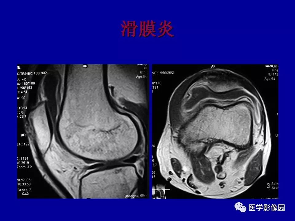 滑膜病变的影像诊断 | 影像天地
