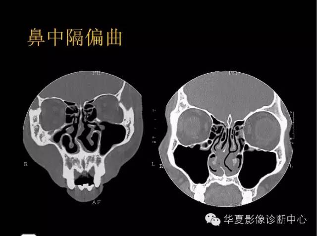 标本 影像,深度剖析 鼻骨,鼻副窦解剖