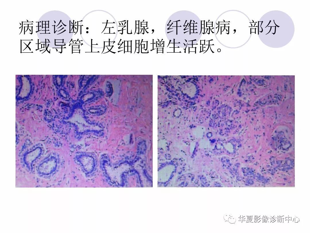 【专业知识】乳腺纤维腺瘤与纤维腺病的区别,您知道吗