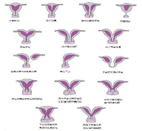 先天性苗勒氏管发育异常:单角子宫,双角子宫,子宫纵隔,双子宫 2.