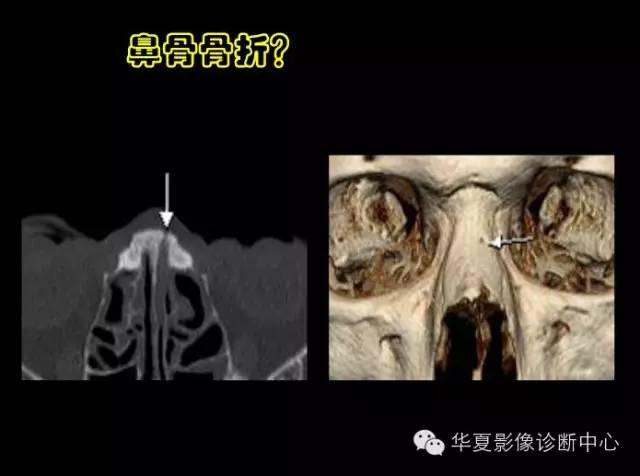 标本 影像,深度剖析 — 鼻骨,鼻副窦解剖