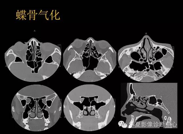 标本 影像,深度剖析 鼻骨,鼻副窦解剖