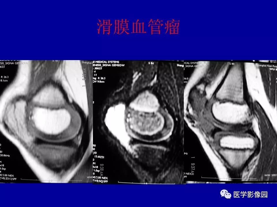 滑膜病变的影像诊断 | 影像天地