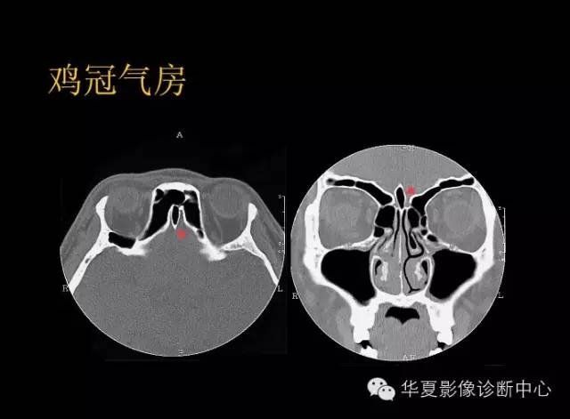 标本 影像,深度剖析 — 鼻骨,鼻副窦解剖