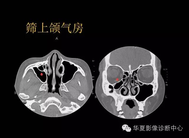 标本 影像,深度剖析 鼻骨,鼻副窦解剖