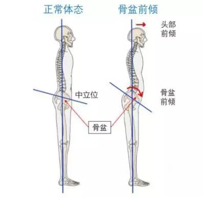 如何判断和矫正骨盆前倾?