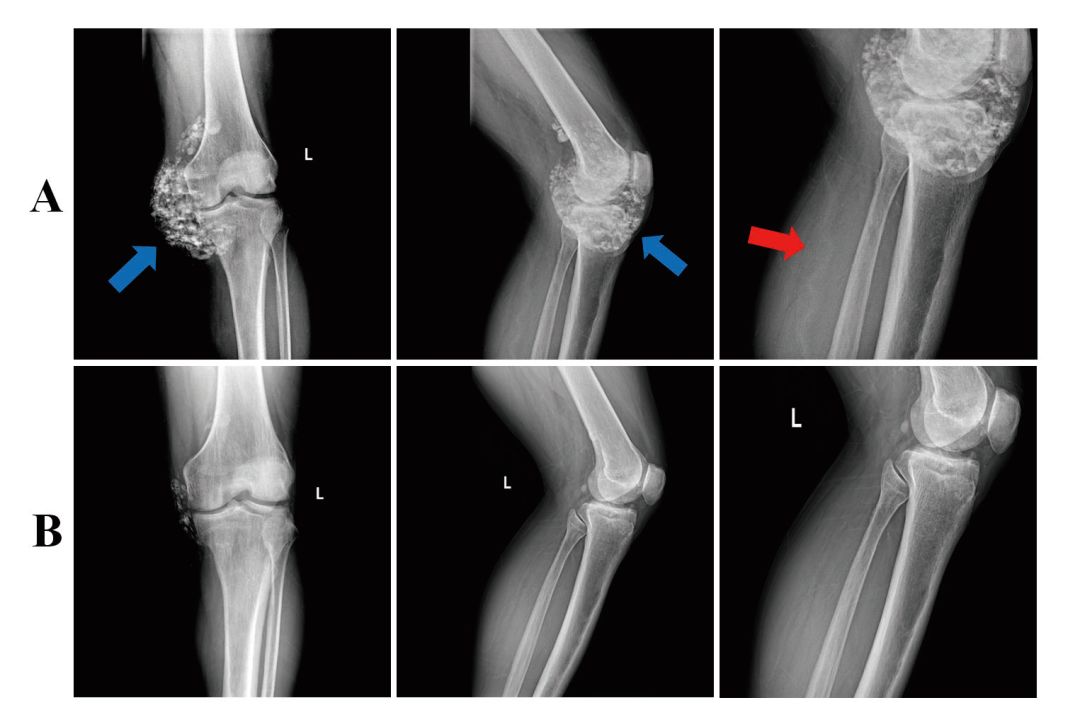 治疗前后膝关节x线平片