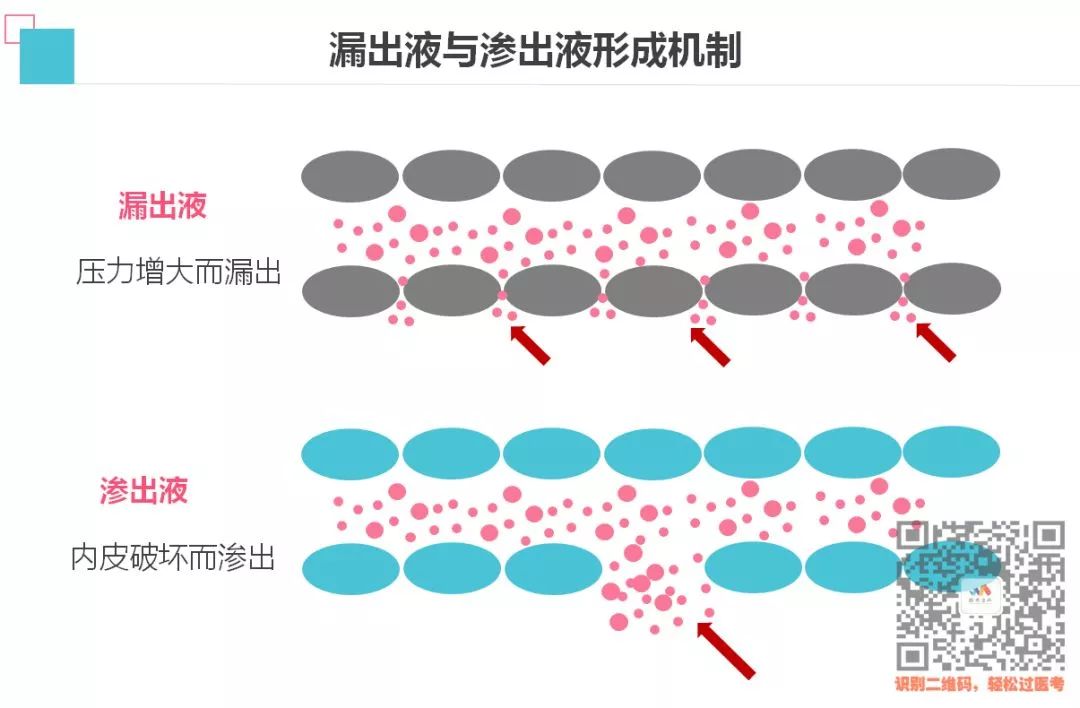 逢考必有的渗出液与漏出液鉴别,其实5分钟就能记住