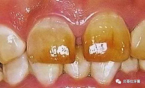 牙釉质发育不良怎么办