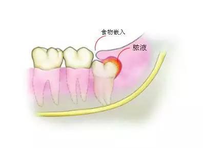 与旁边牙齿的邻接关系正常,且与颌智齿的咬合关系正常的智齿是不需要