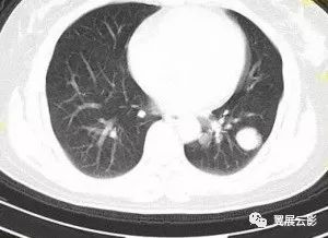 【病例】胸痛,左肺见结节状混杂密度影,见斑点