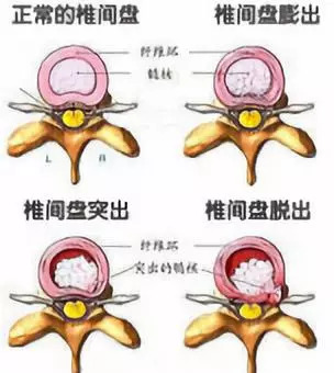 这跟你的用腰习惯有很大关系,长时间弯腰,脊椎骨长期处于向后张开的