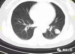 【病例】胸痛,左肺见结节状混杂密度影,见斑点