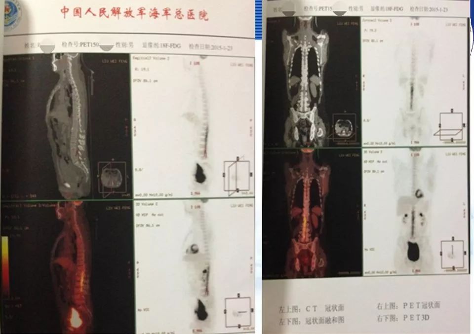 [演讲]海军总医院王亚明:原发性中枢神经系统淋巴瘤(pcnsl)的立体定向