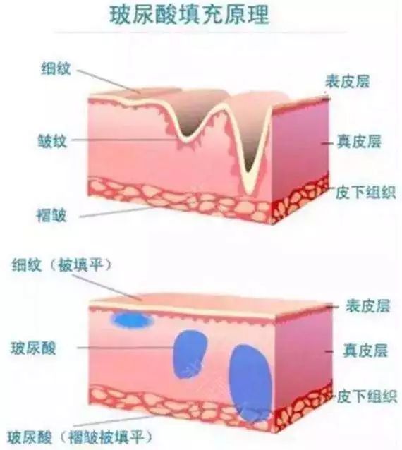 玻尿酸的原理是什么_玻尿酸的原理