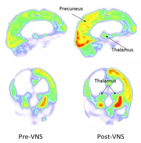 图8:迷走神经刺激后明显增加了丘脑和前楔叶的代谢,这些都是脑网络中
