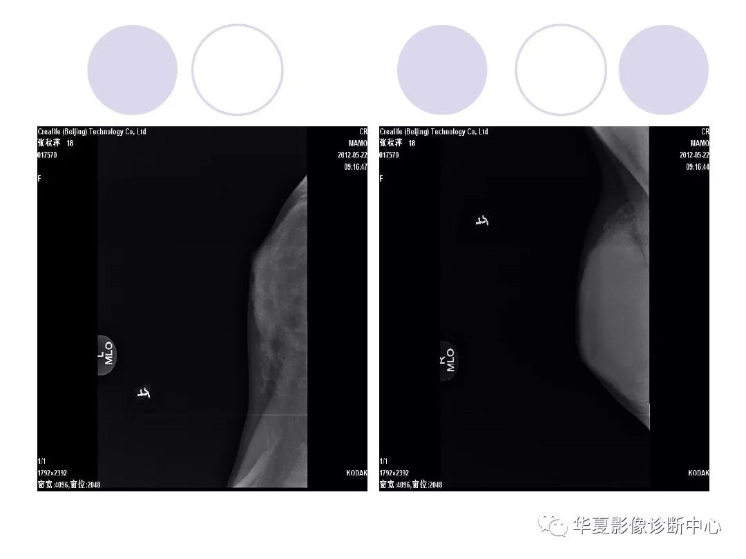 【每日一例| 658例】乳腺纤维腺瘤与纤维腺病的区别,您知道吗?