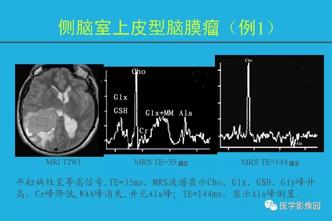 脑膜瘤的质子磁共振波谱分析 | 影像天地