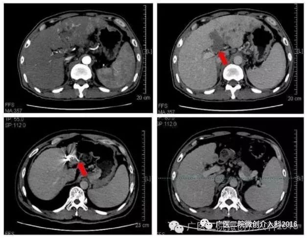 门静脉癌栓形成的介入治疗1病 例 分 享广州医科大学附属第二医院
