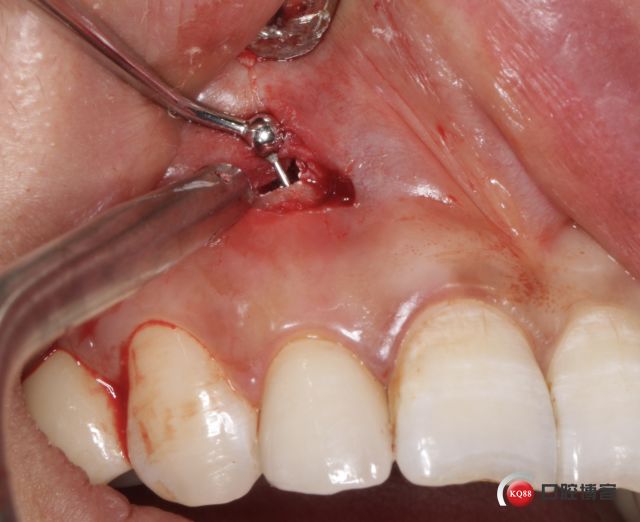 上前牙根尖手术病例