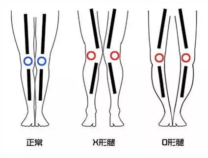 腿不直，小腿弯曲怎么矫正？