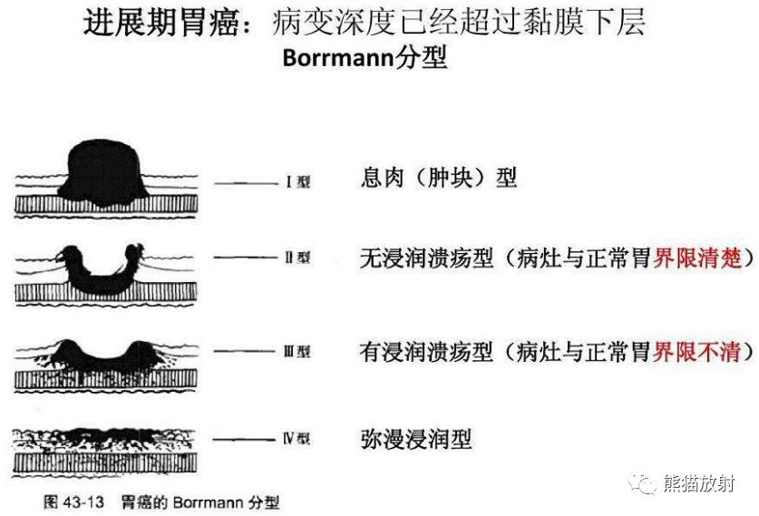 x线诊断要点丨胃肿瘤的那些概念和征象