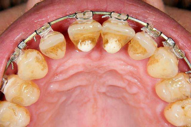 如使口腔酸性变强导致菌群病变,引发口臭,牙黄,牙龈炎,牙周炎等症状