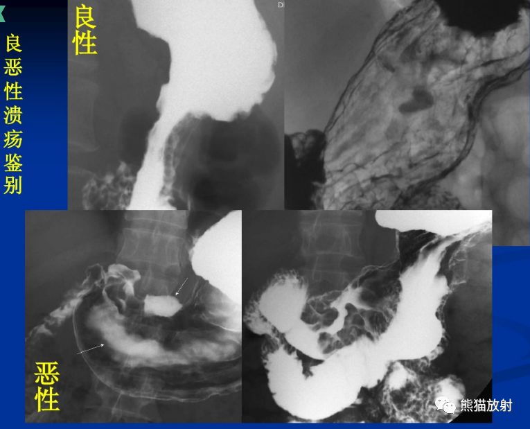 x线诊断要点丨胃肿瘤的那些概念和征象