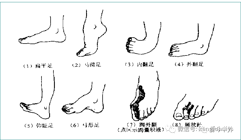 足踝部损伤检查法 1.常见的足部畸形