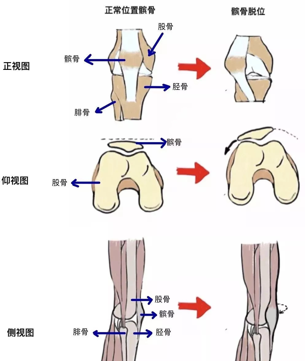 你的髌骨可能"脱轨"了!