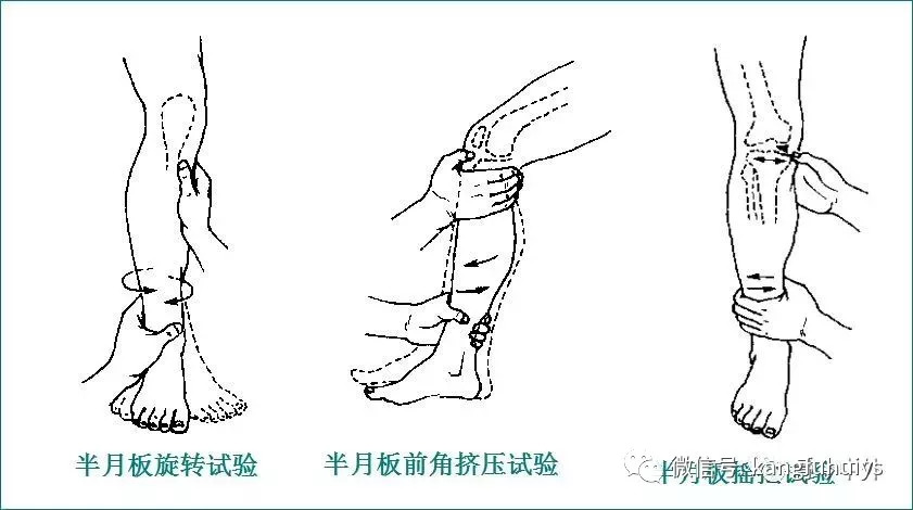 踝部前抽屉试验 责任编辑