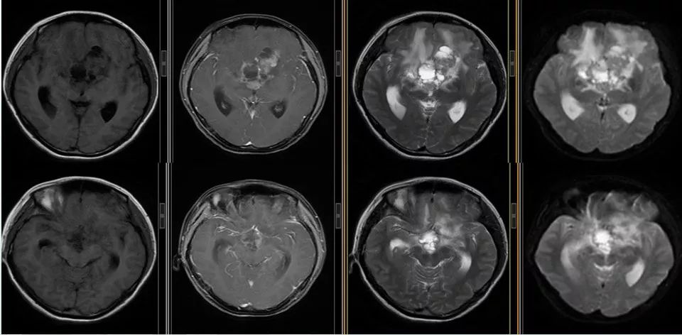 [病例讨论]湖南省肿瘤医院韩亚骞:一例颅内非纯生殖细胞性生殖细胞