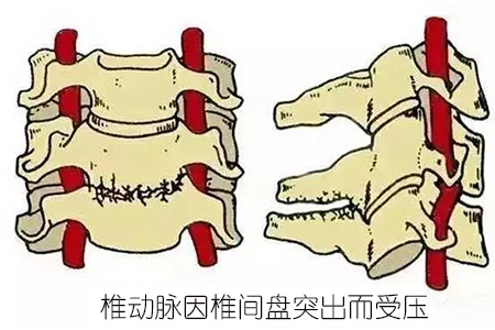 交感神经型颈椎病