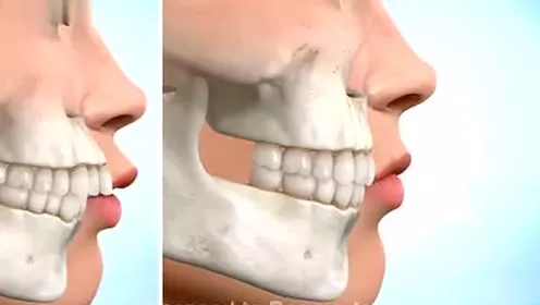 上颌前突畸形双颌前突畸形上颌前突畸形,一般来说采取的正颌手术方式