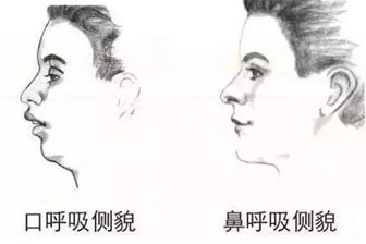 "口呼吸",是指儿童长期用嘴呼吸而导致气流冲击硬腭,可能形成错颌