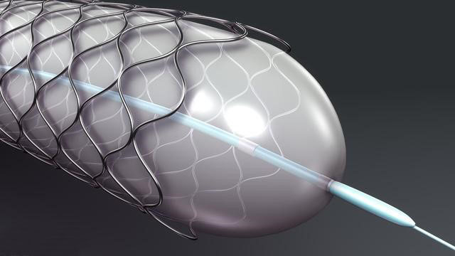 心血管医生告诉您:进口心脏支架和国产心脏支架有区别