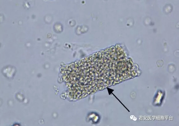 看图识细胞之卫生部2018年尿液沉渣形态学质控