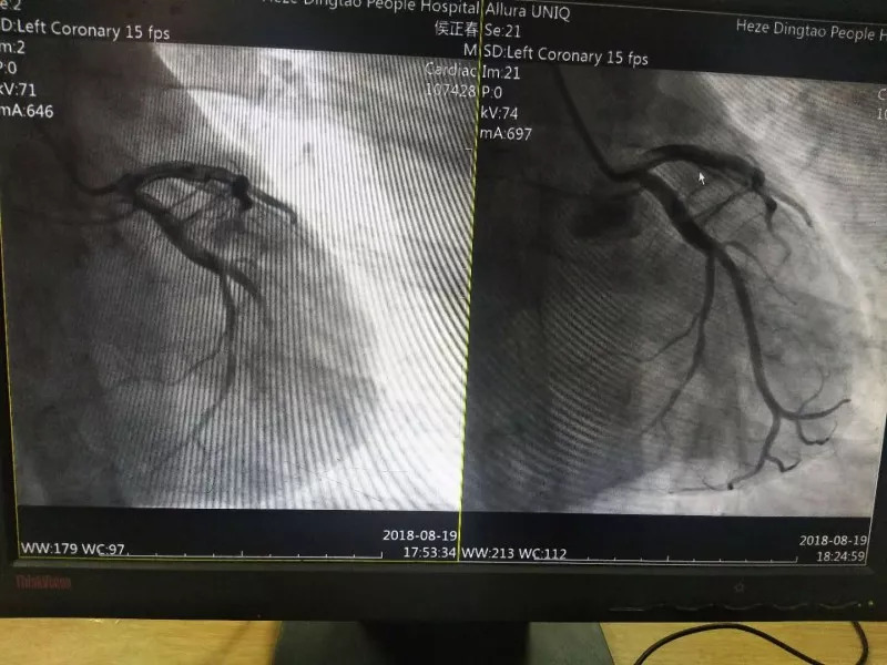 冠脉造影结果及支架植入后对比