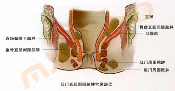 肛门息肉怎么办