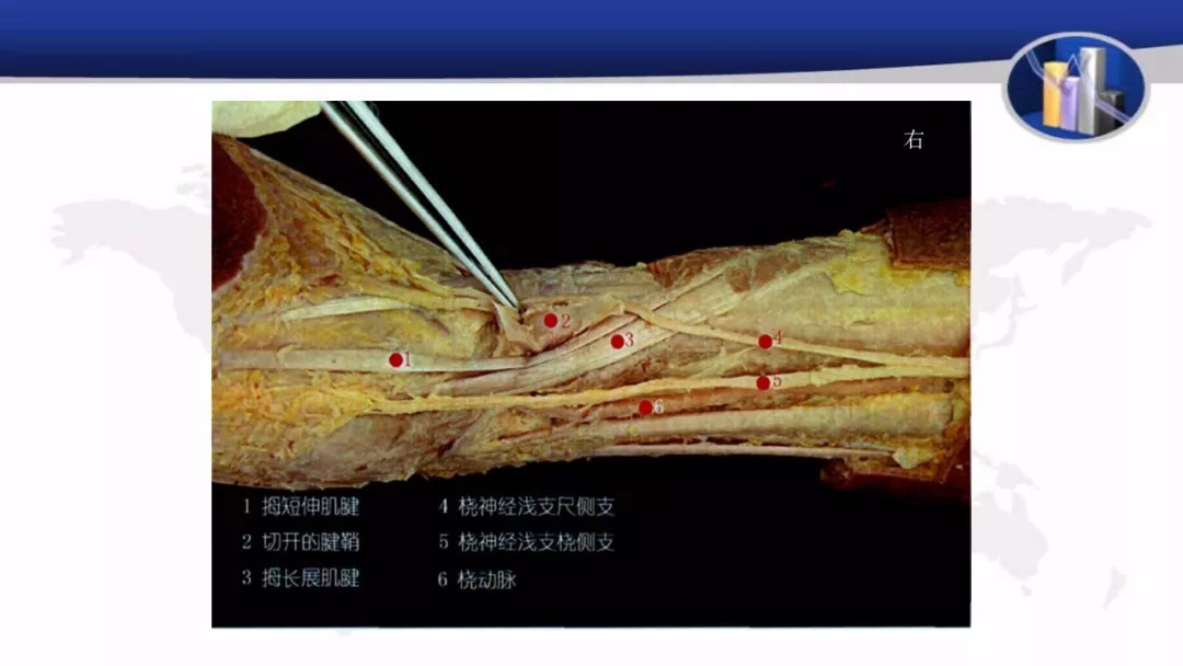 2是切开的腱鞘,4,5就是桡神经浅支在桡骨茎突处的两个分支,6是桡动脉