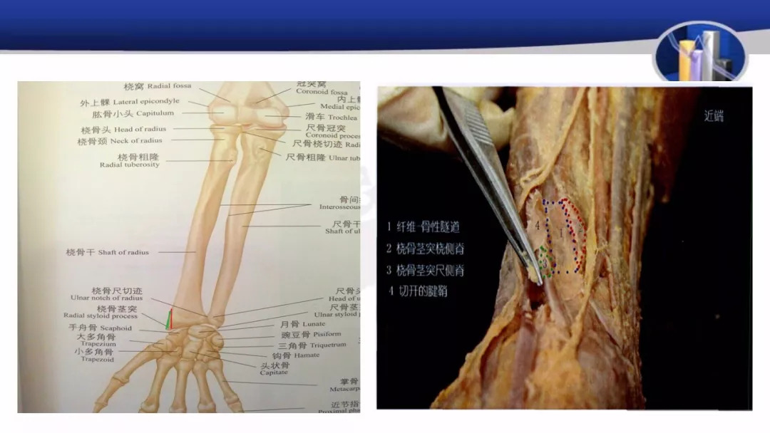 桡骨茎突狭窄性腱鞘炎一