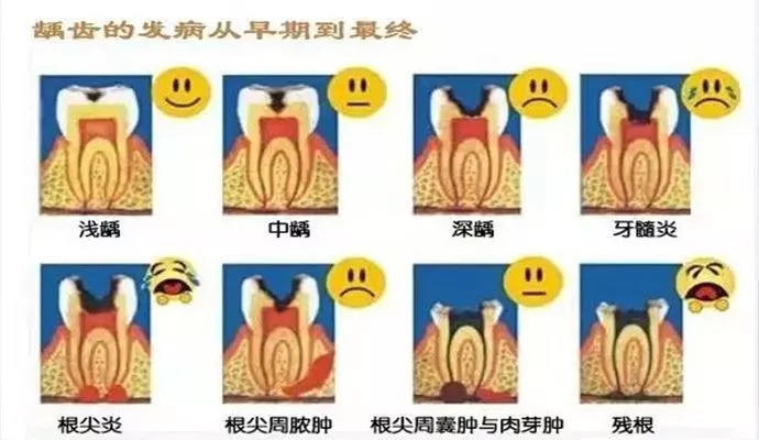 牙齿龋坏后怎么解决?有3种方法,可根据龋洞大小做对应选择.