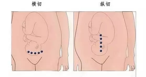 剖腹产会留疤怎么破?妇幼保健院的这项绝活,让你"完美如初"