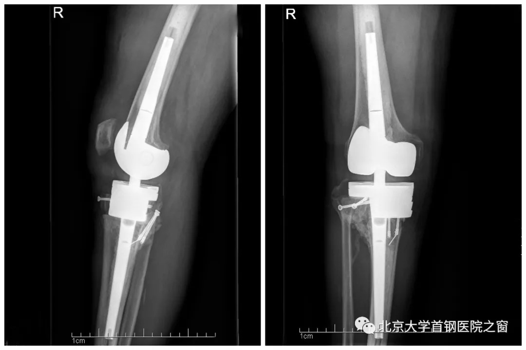 大学首钢医院骨科成功完成首例复杂夏科氏膝关节炎人工关节置换手术