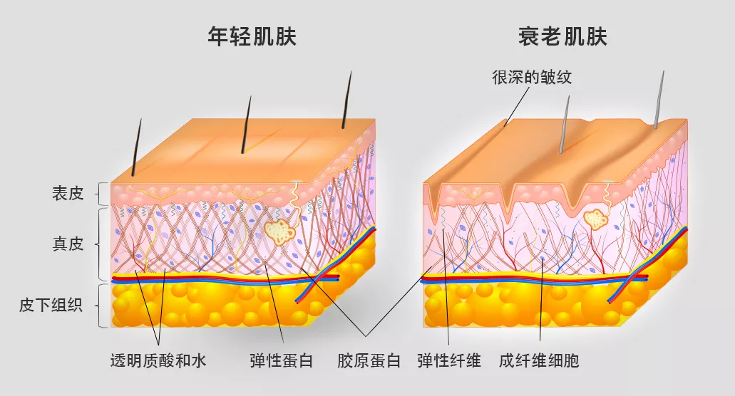 我们皮肤的胶原蛋白,弹性蛋白越来越少,整个真皮层的网状结构受损