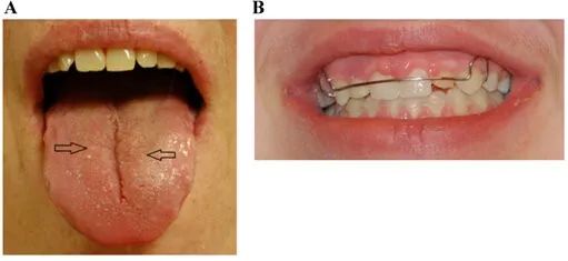 a图舌头的乳头状瘤;b图牙龈乳头状瘤